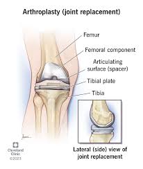 Arthoplasty - Unique Surgicare